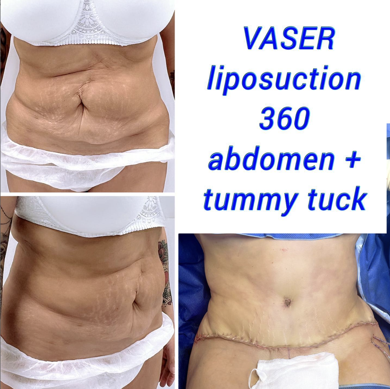 Tummy tuck and VASER liposuction