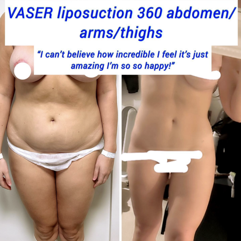 VASER liposuction