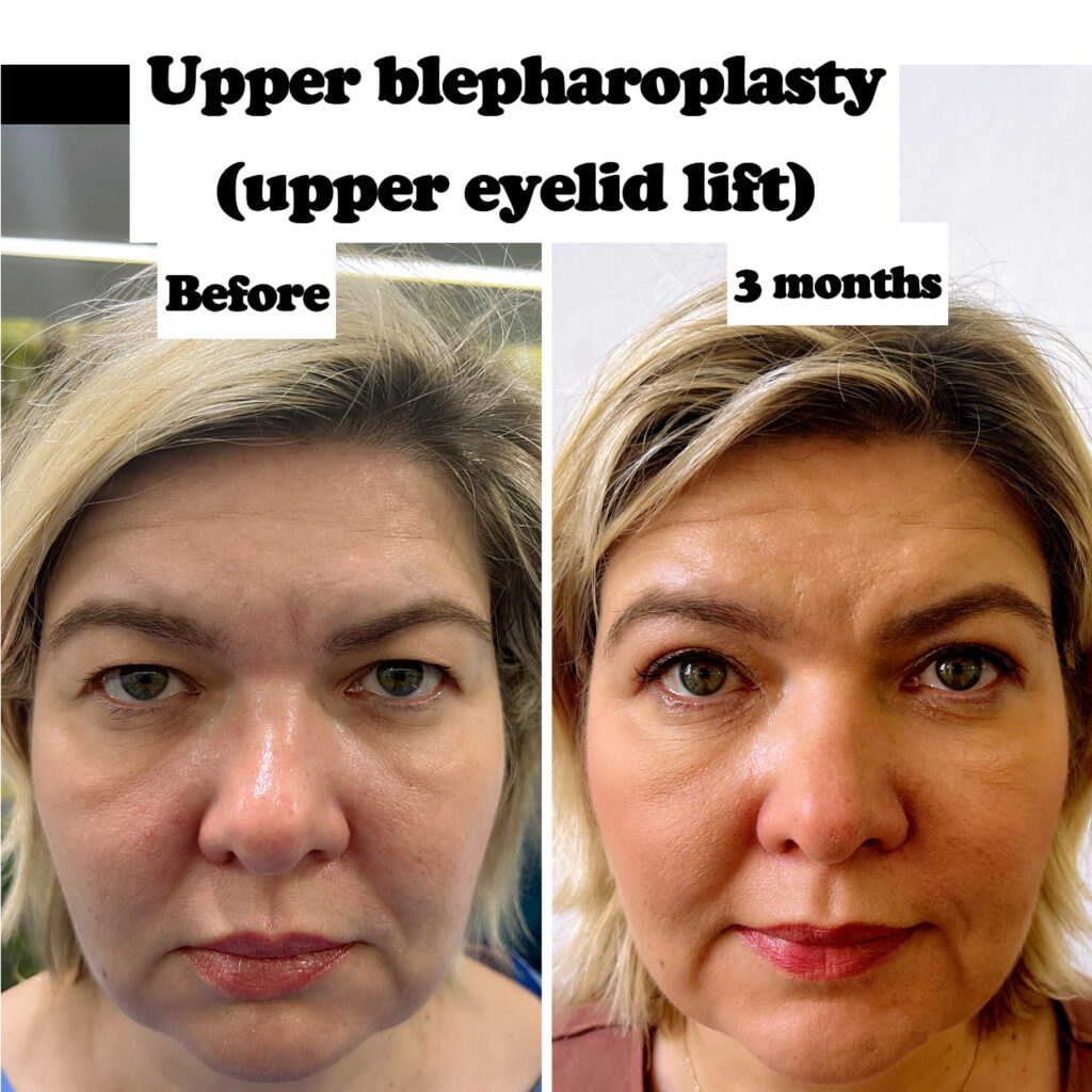 Upper blepharoplasty