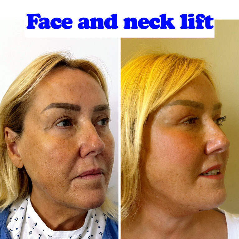 face and neck lift