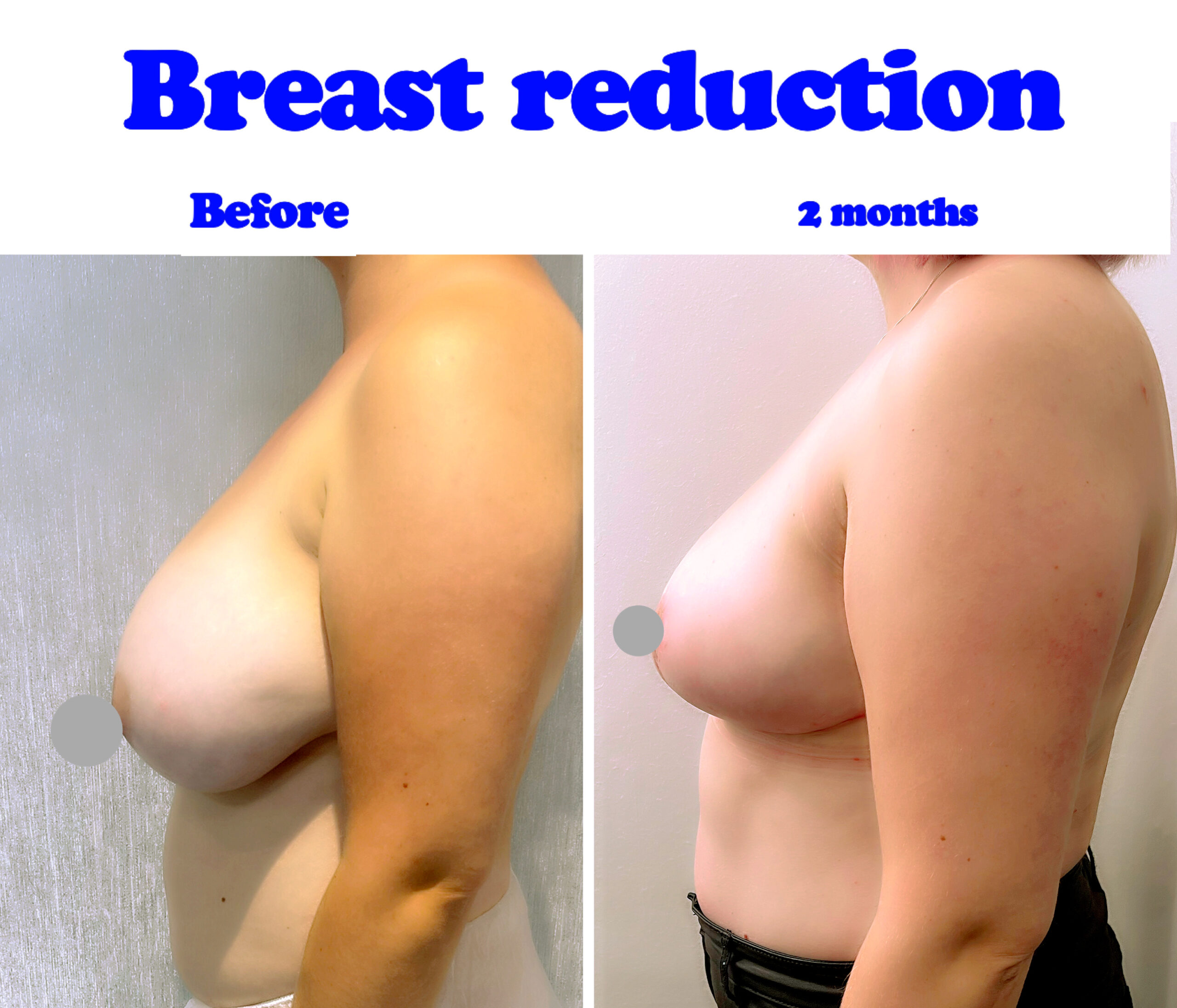 Breast reduction