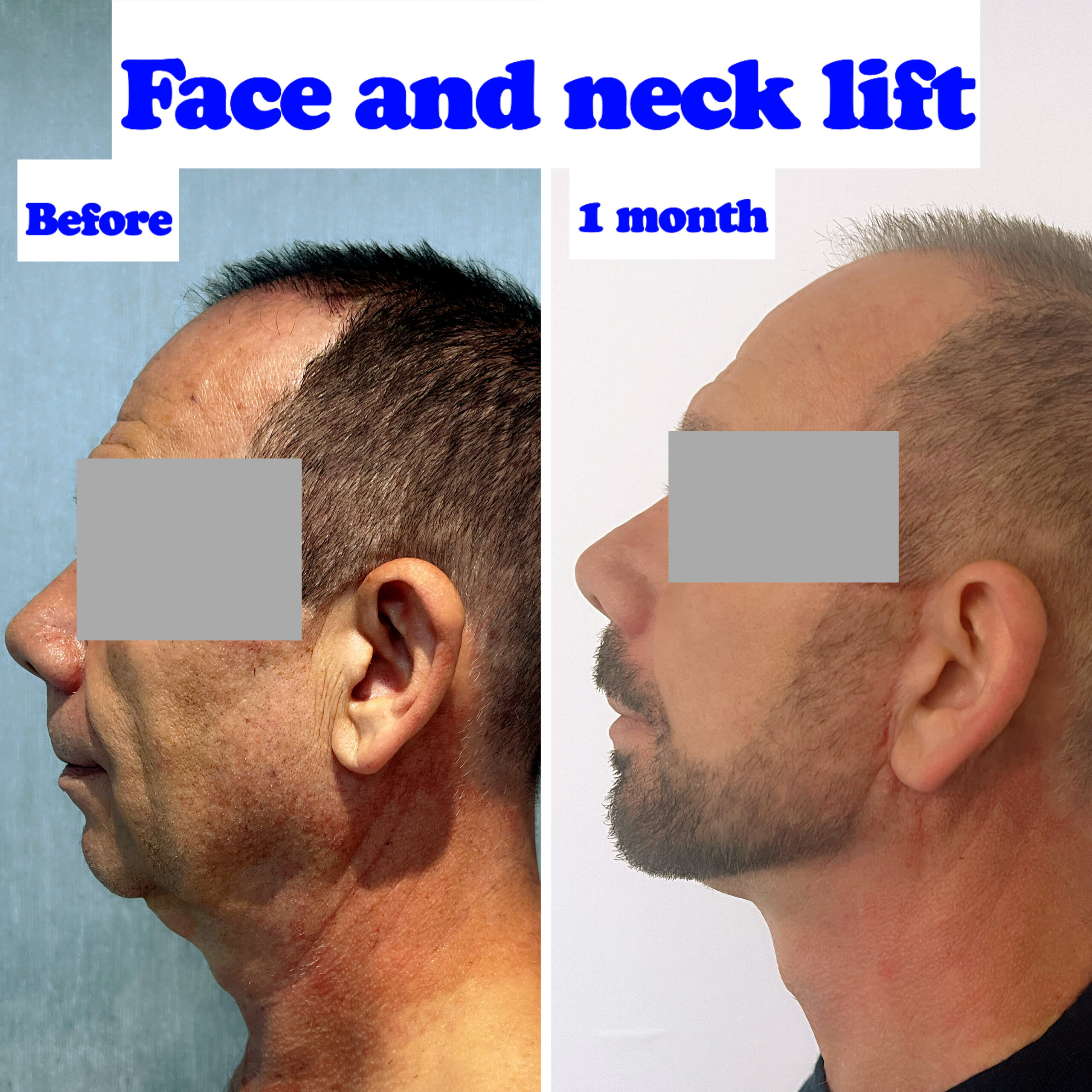 Face and neck lift