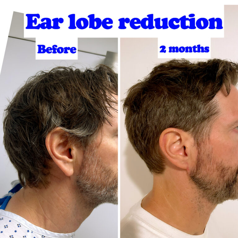 Ear lobe reduction