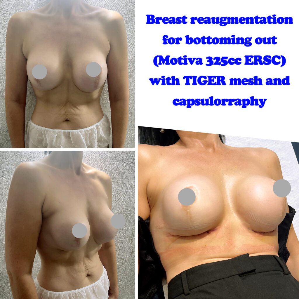 breast reaugmentation