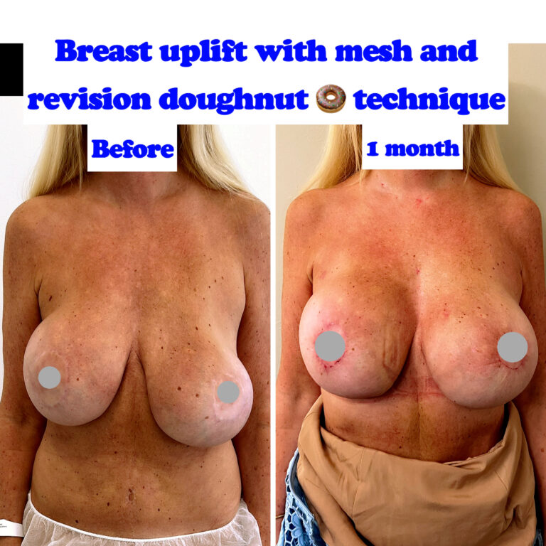 breast augmentation with mesh and uplift