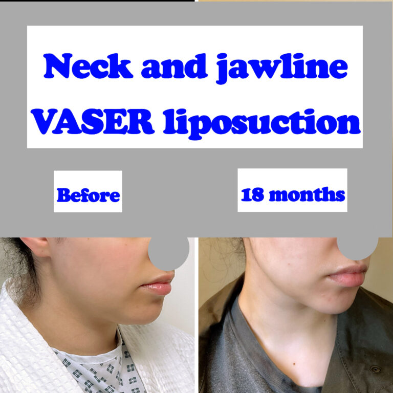 submental, jawline and neck liposuction