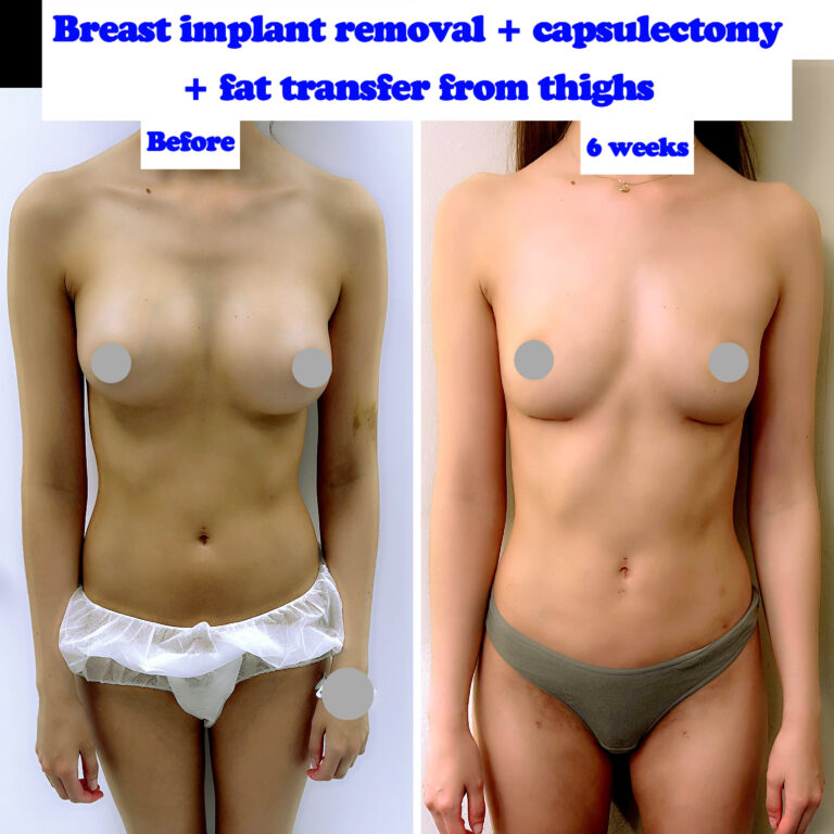 How Long Is My Recovery After Breast Implant Removal?