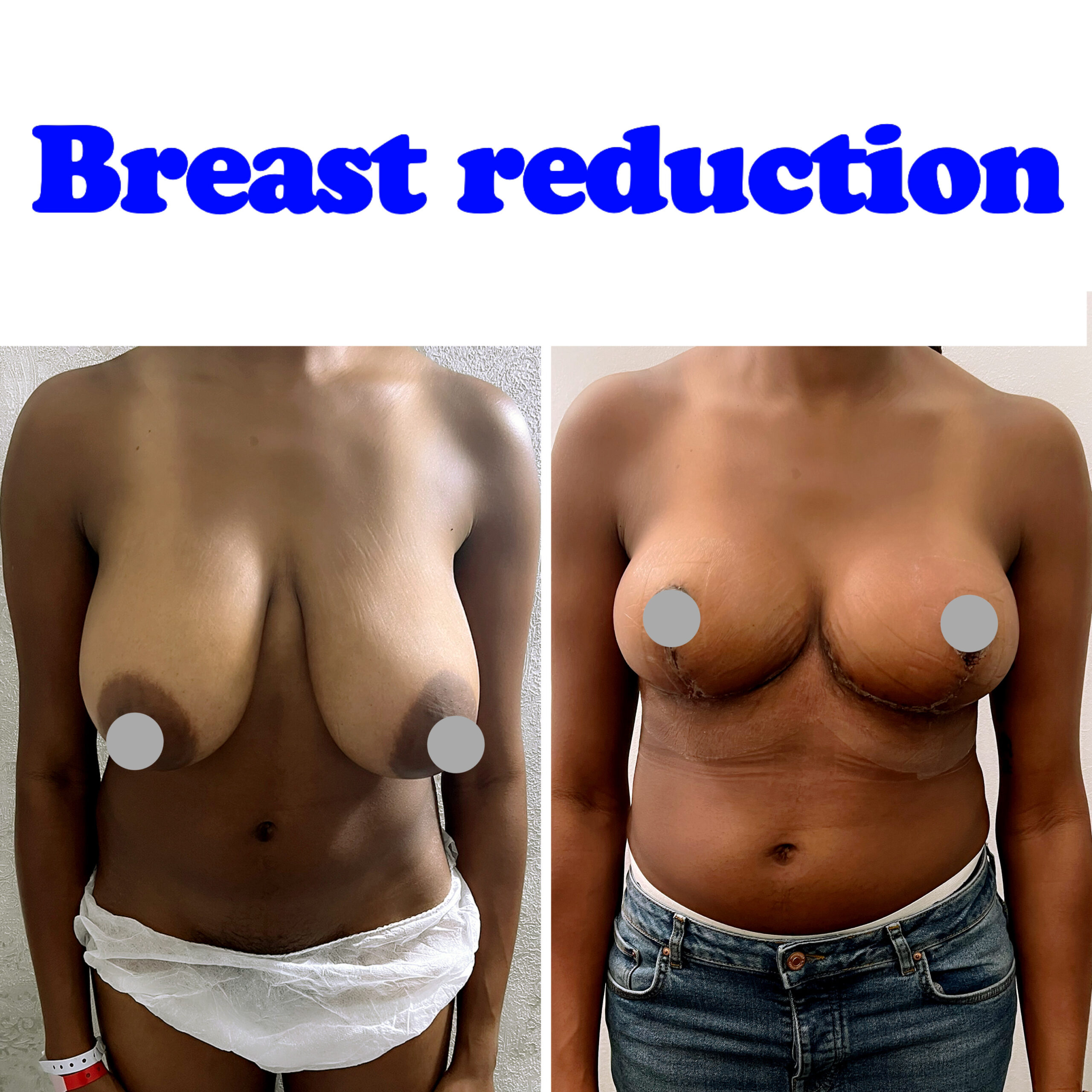 Breast reduction