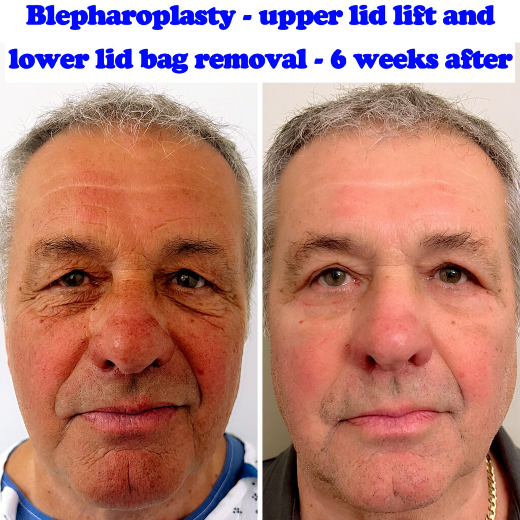 Upper and lower blepharoplasty