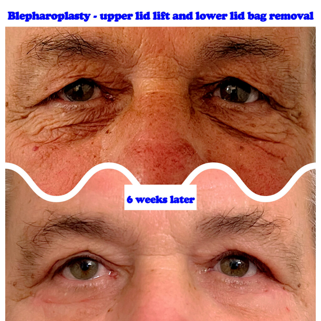 Upper and lower blepharoplasty