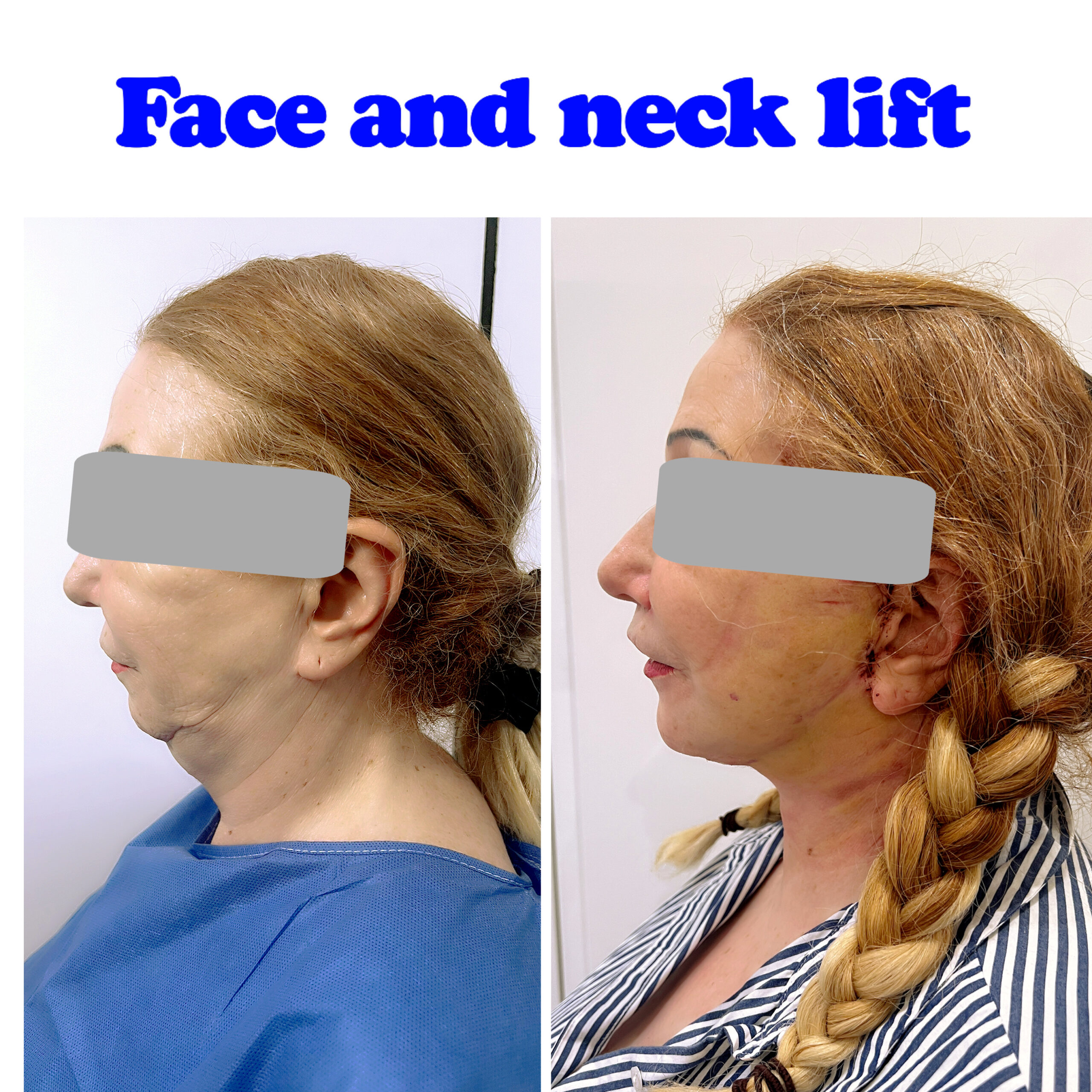 Face and neck lift