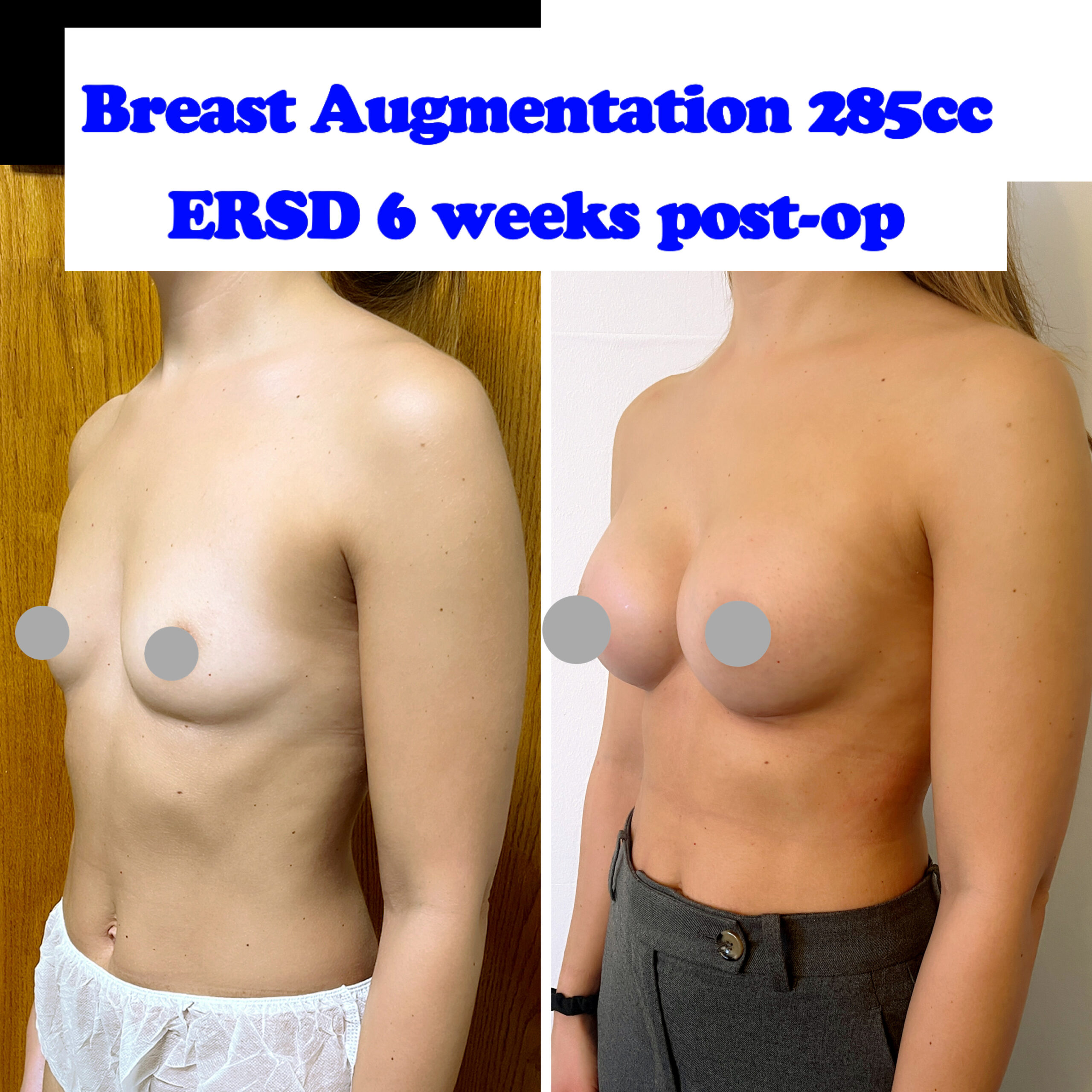 Breast Augmentation (breast implants)