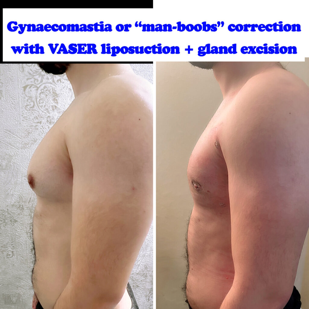 Gynaecomastia correction (man boobs surgery)