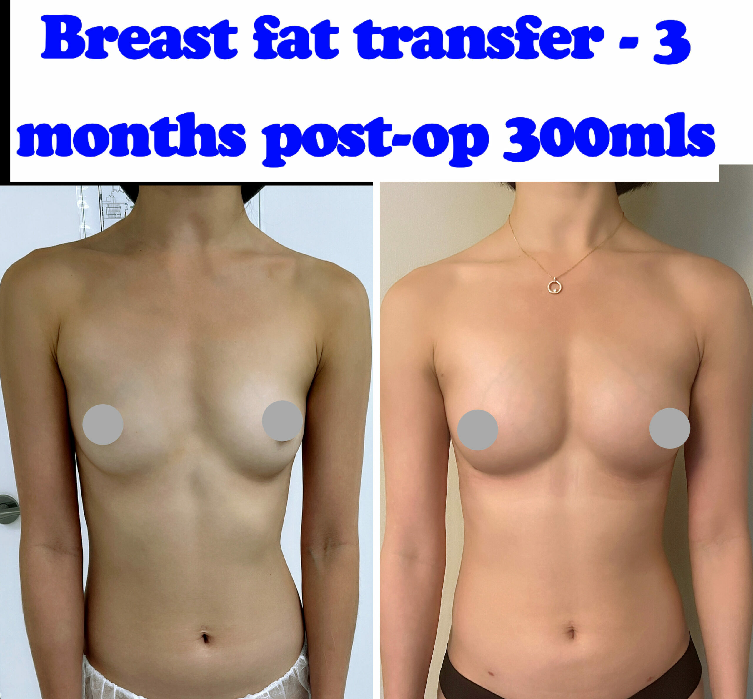 Fat transfer breast augmentation small breasts before after photos at Harley Clinic in London, UK