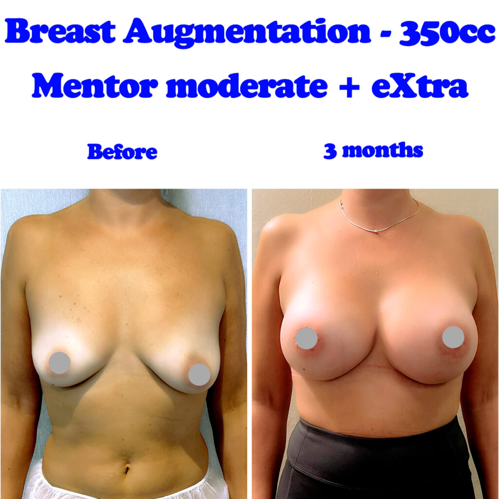 Breast augmentation before and after at Harley Clinic in London, UK