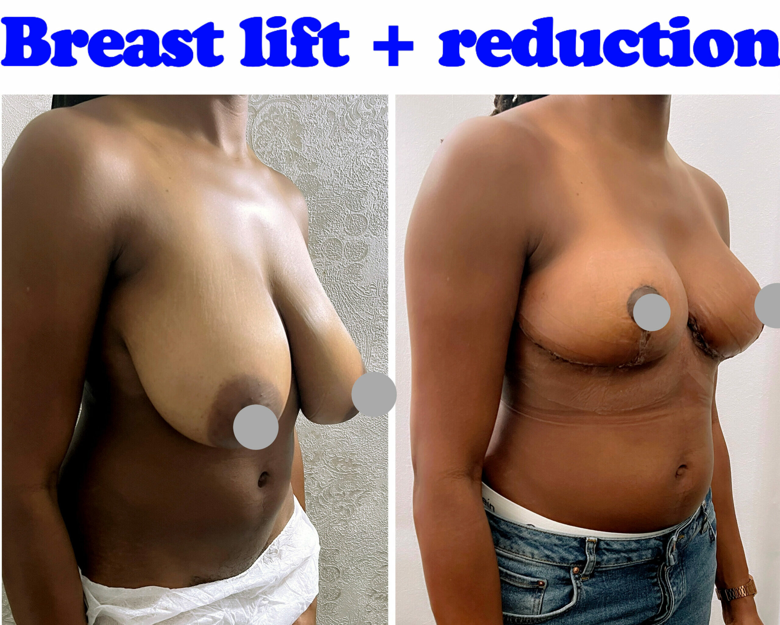 Breast lift and reduction before and after photos at Harley Clinic in London, UK