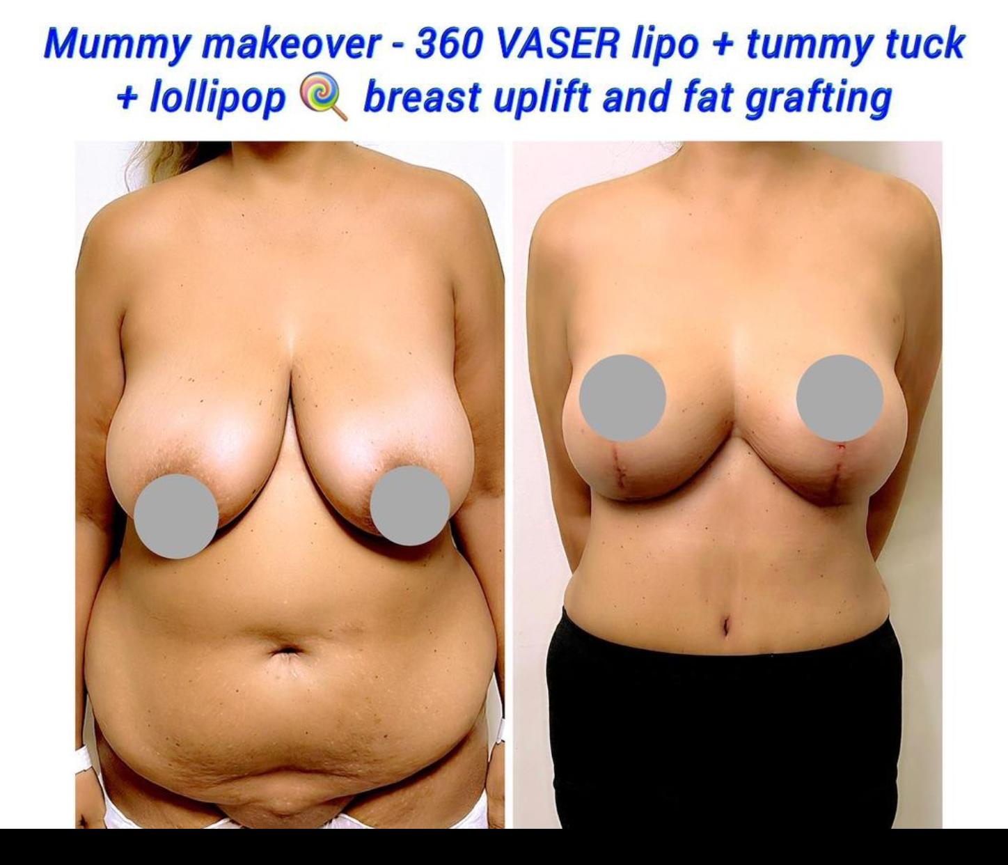 Mummy makeover in London, UK. Breast lift, tummy tuck and vaser liposuction. Tummy tuck scar minimal.