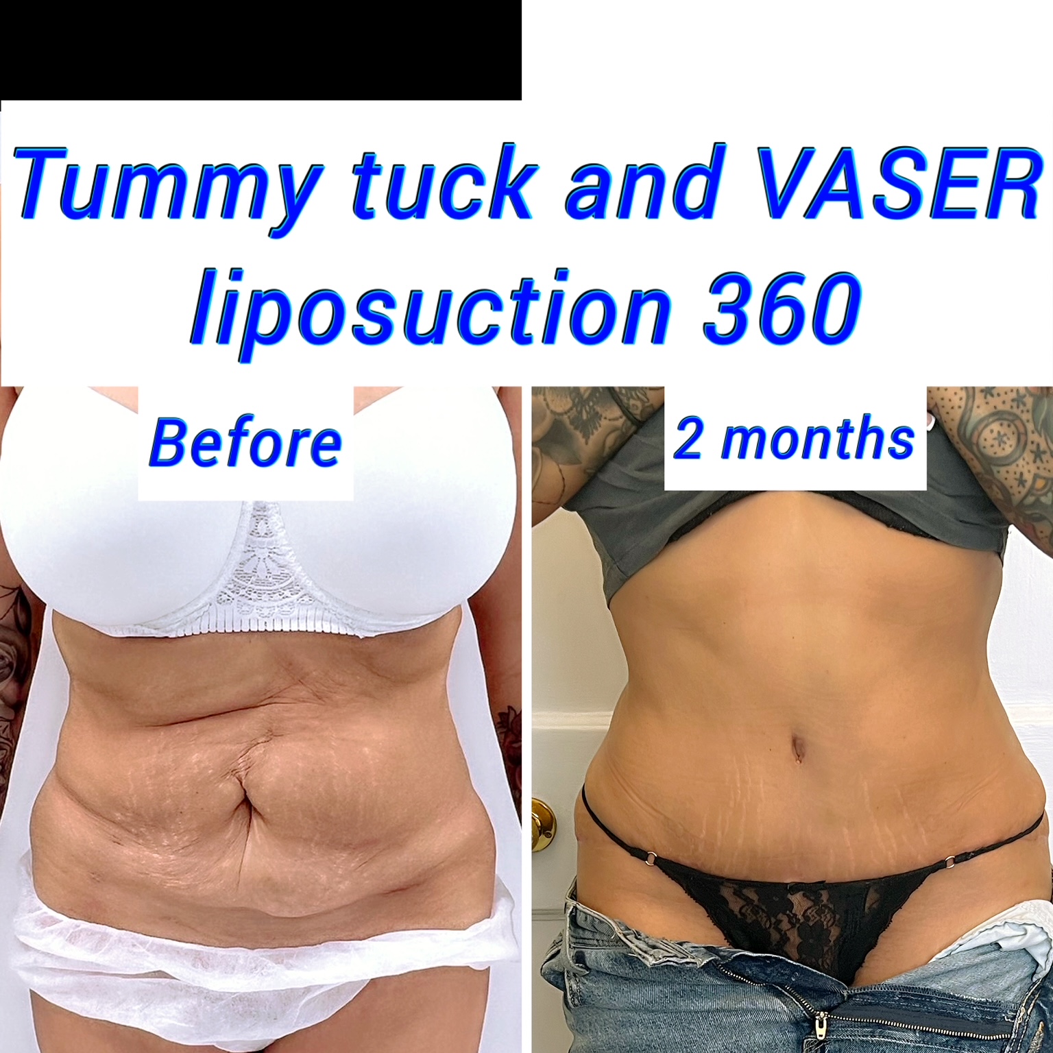 Tummy tuck before and after photos Harley Clinic London, UK