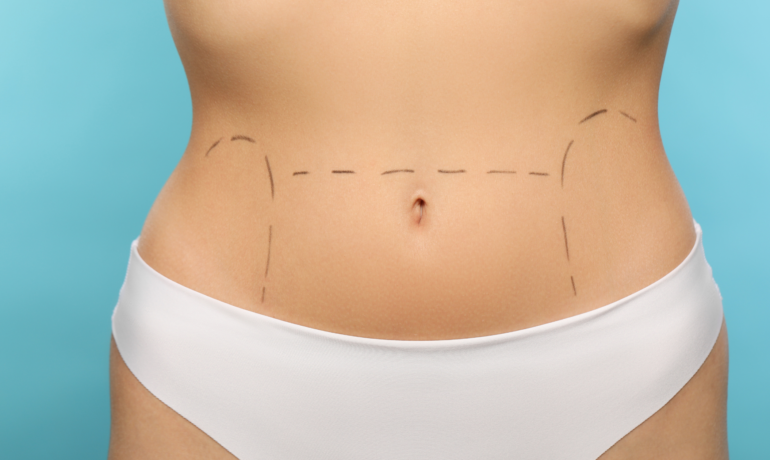 How to fix an overhanging belly with a tummy tuck