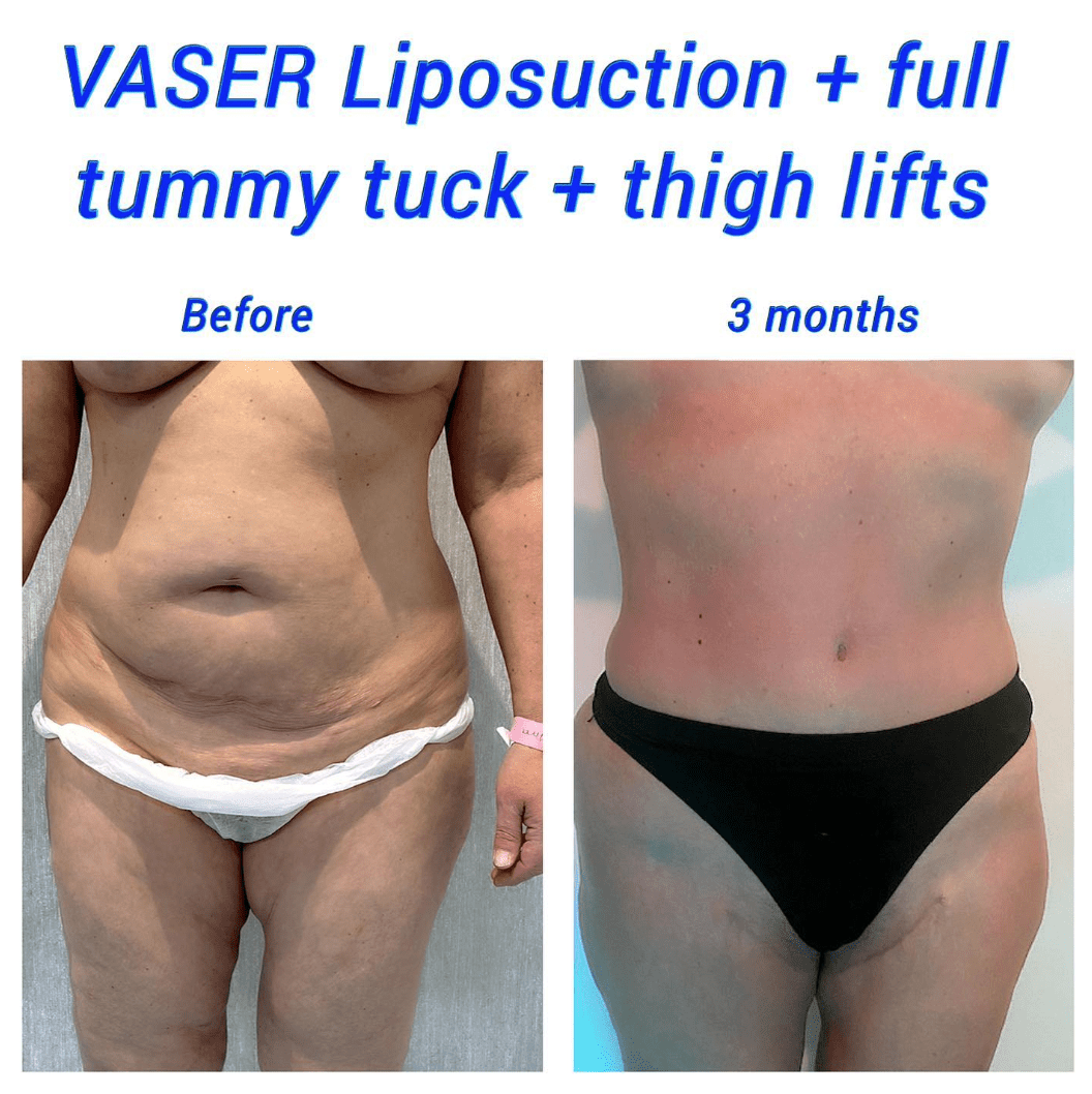 VASER liposuction and tummy tuck with thigh lift. Minimal tummy tuck scar.