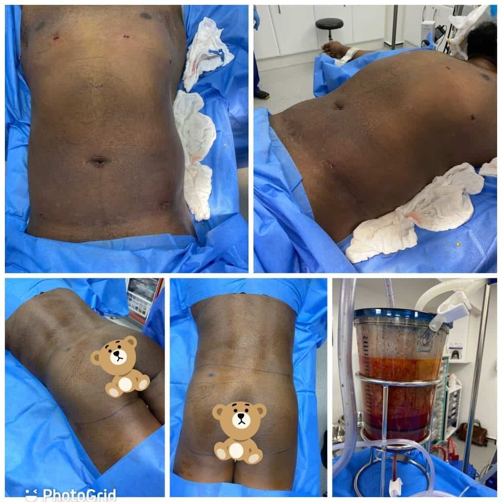 Gynaecomastia surgery