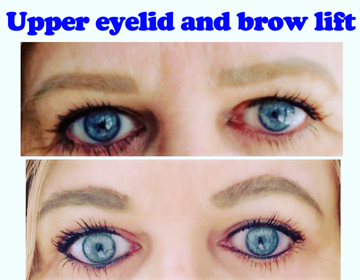Eyelid surgery and brow lift