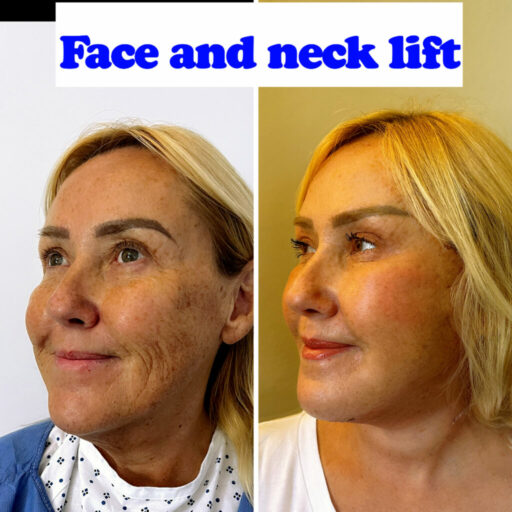 Facelift Facelift Before and After Photos, Face Rejuvenation Surgery Explained
