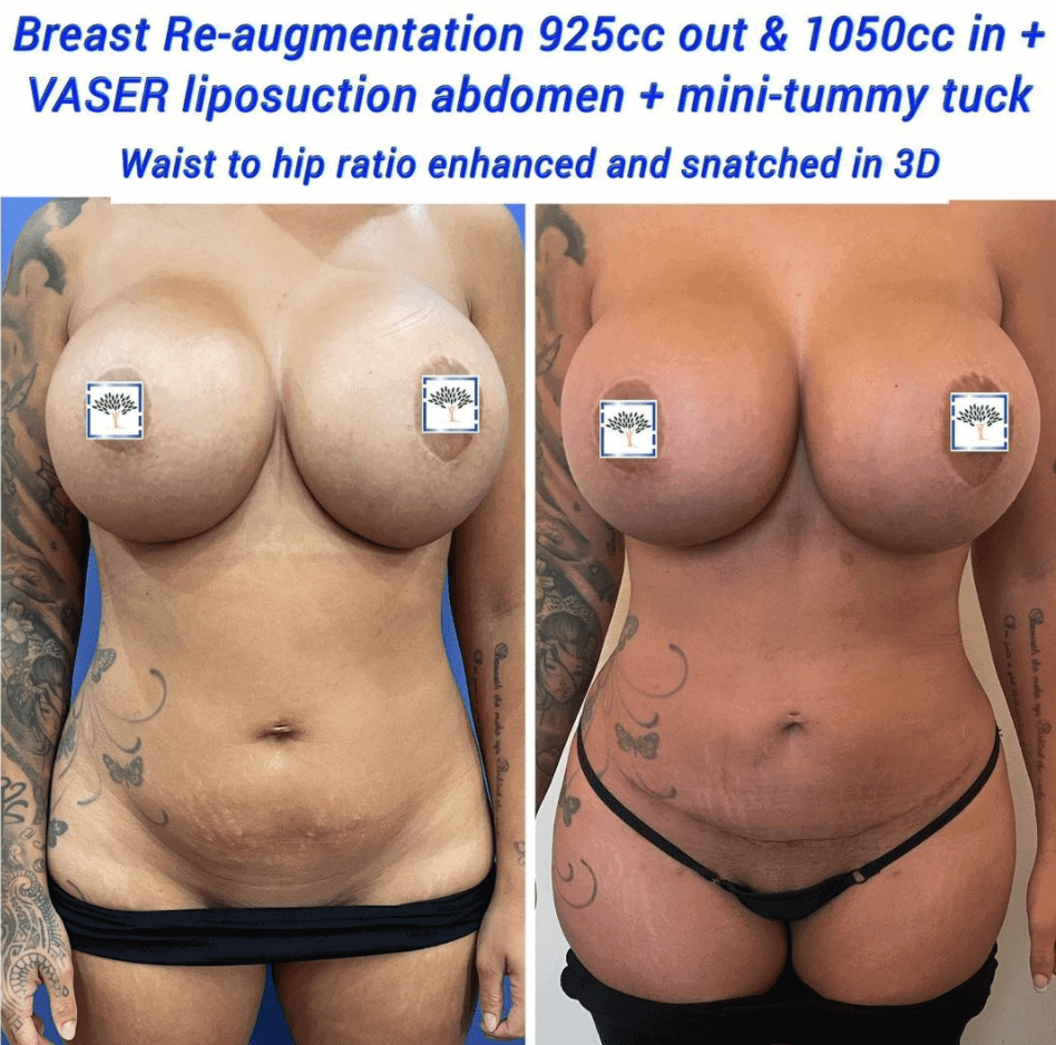 Tummy Tuck UK