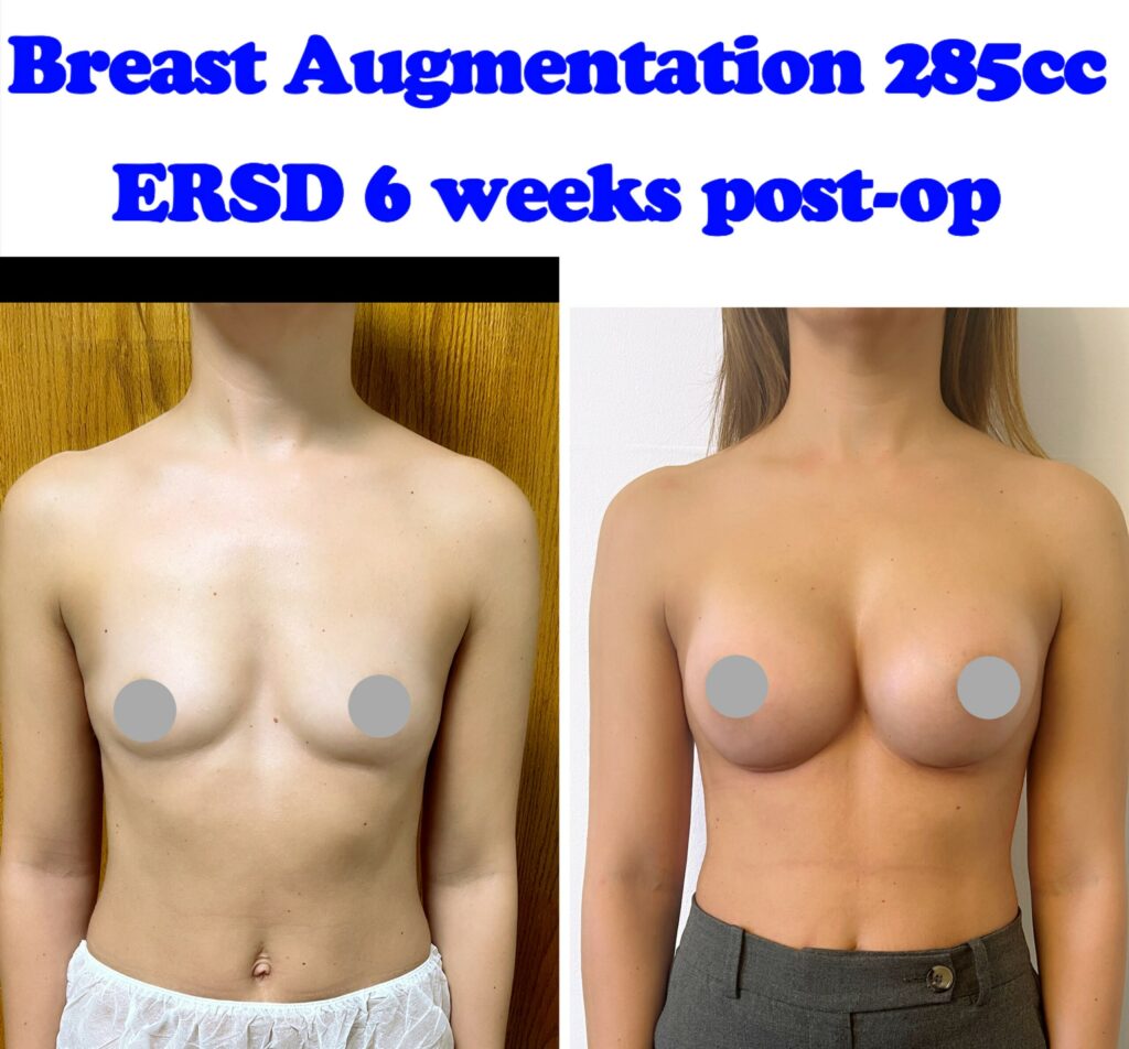 Breast Augmentation Small Implants