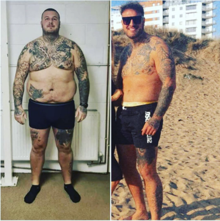 Man before and after male breast reduction surgery