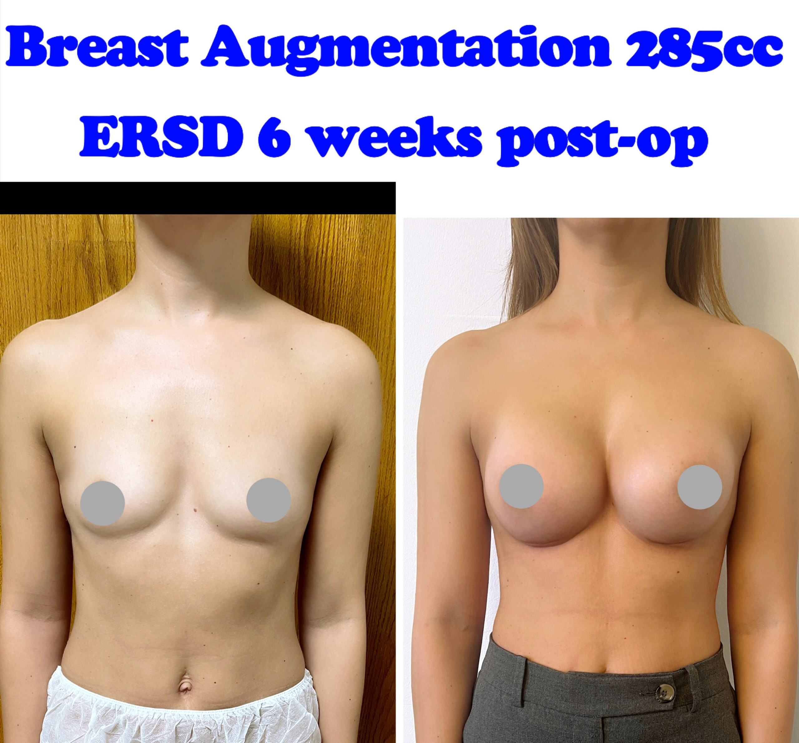 Breast enlargement surgery video
