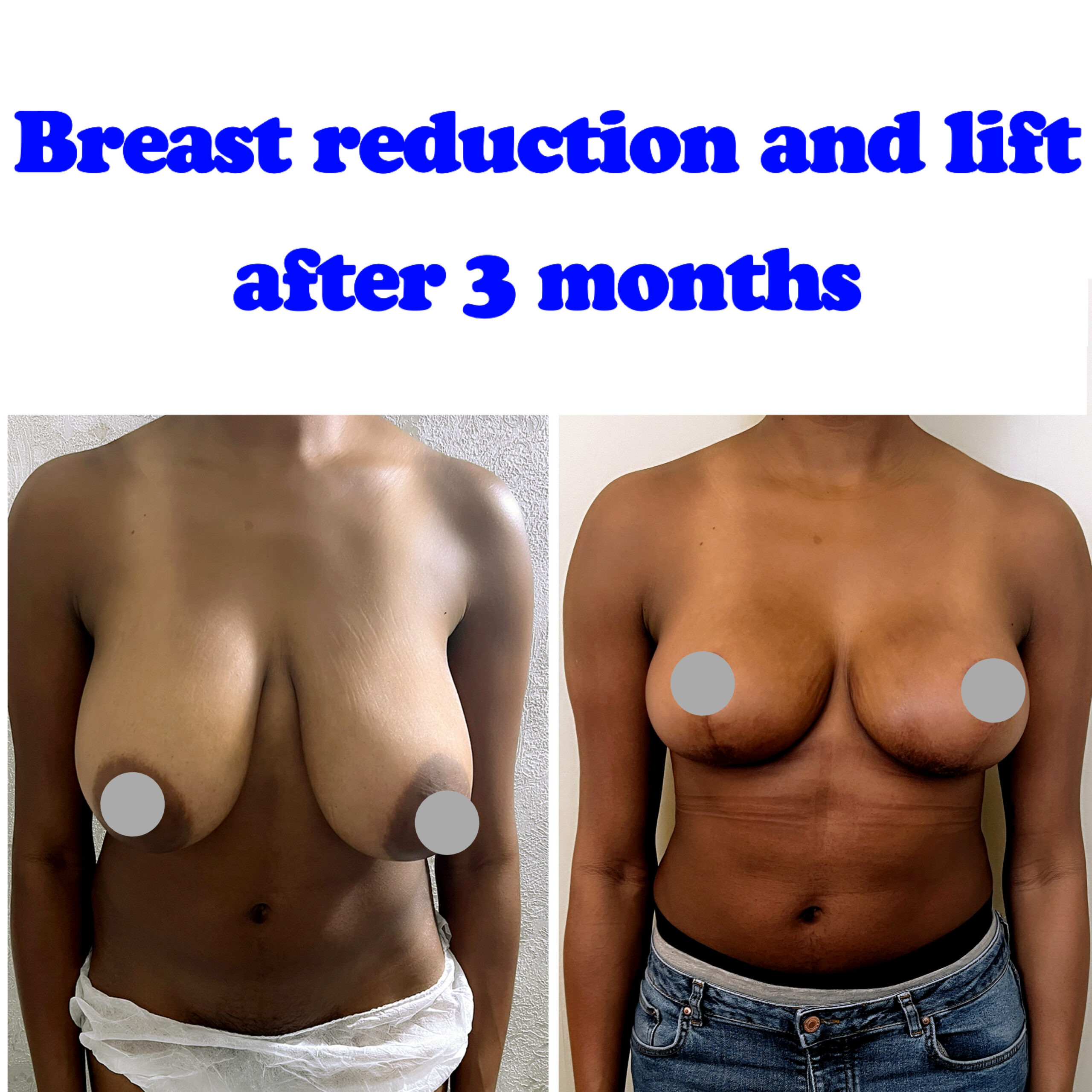 breast reduction UK