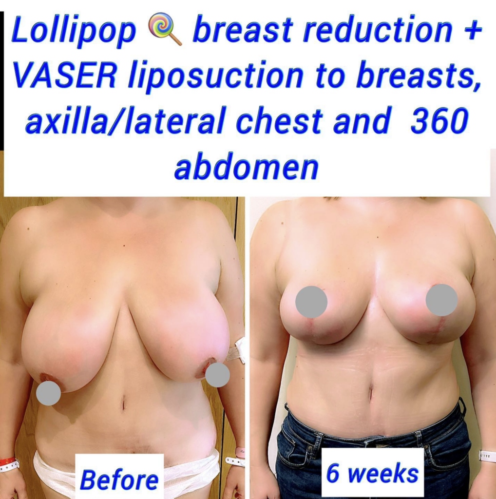 breast reduction UK