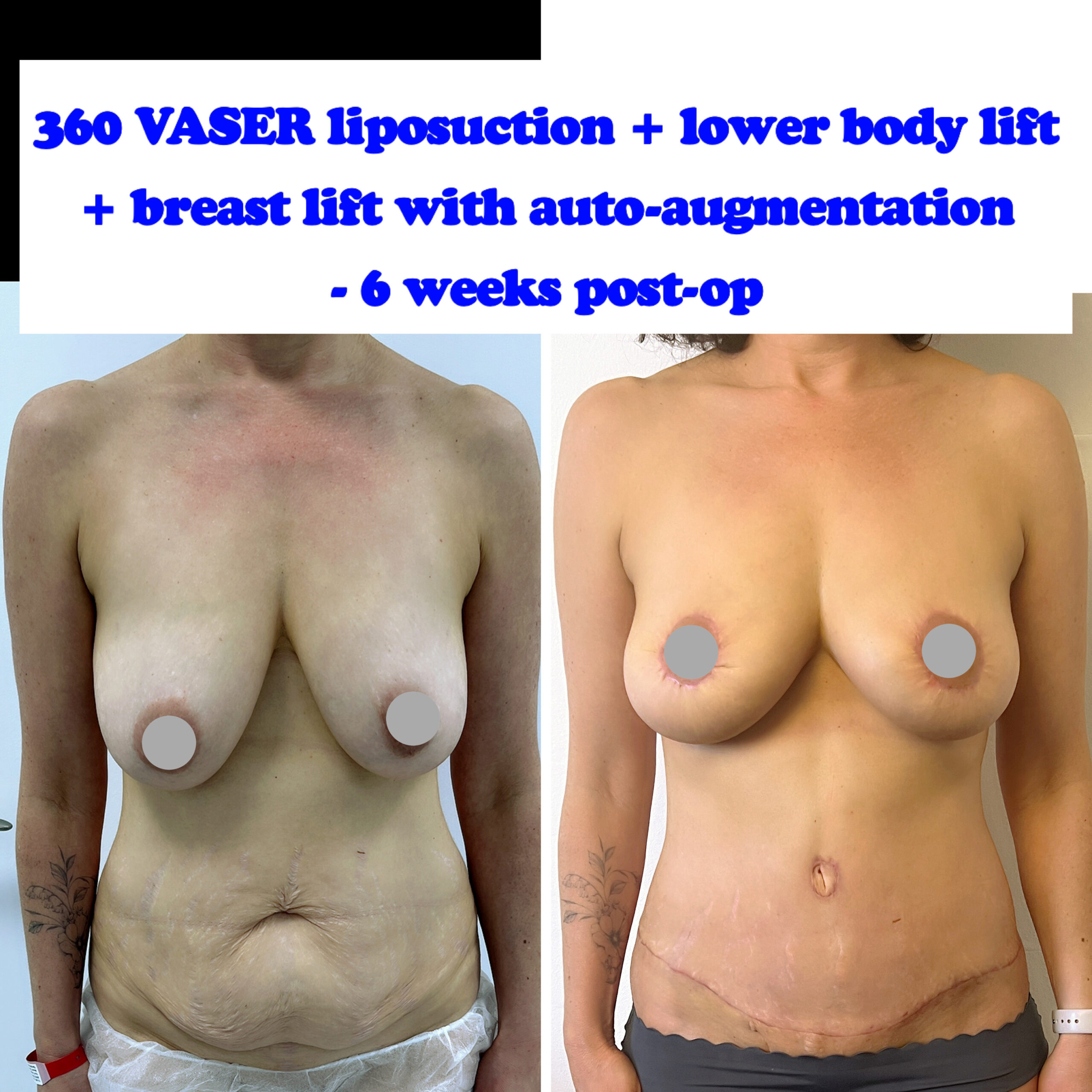 cost of a mummy makeover