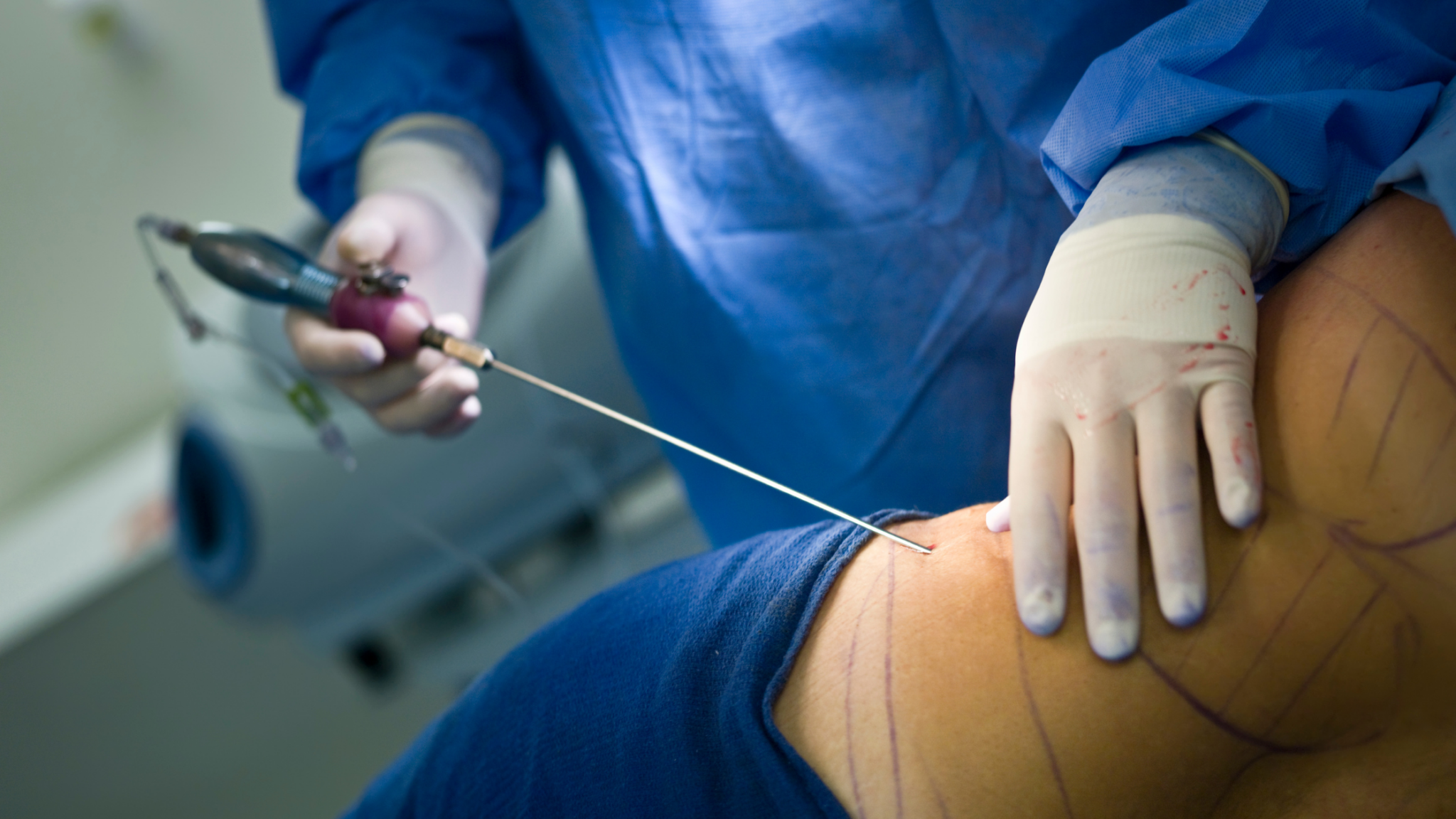Liposuction Surgery and Weight Loss: What You Can Expect