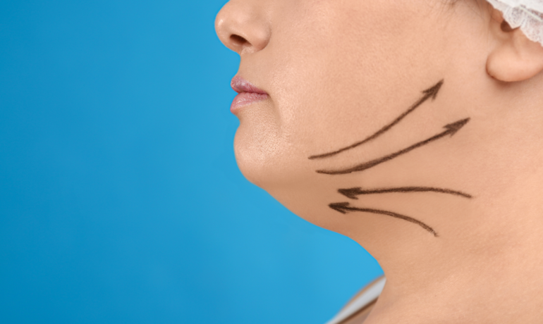 chin liposuction