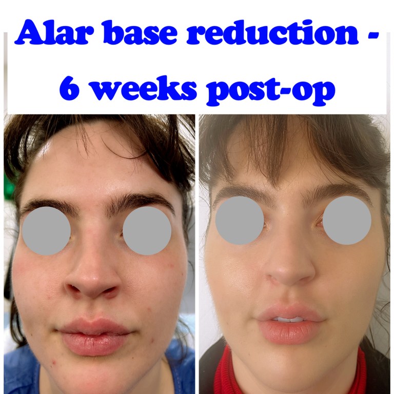 Alar base reduction