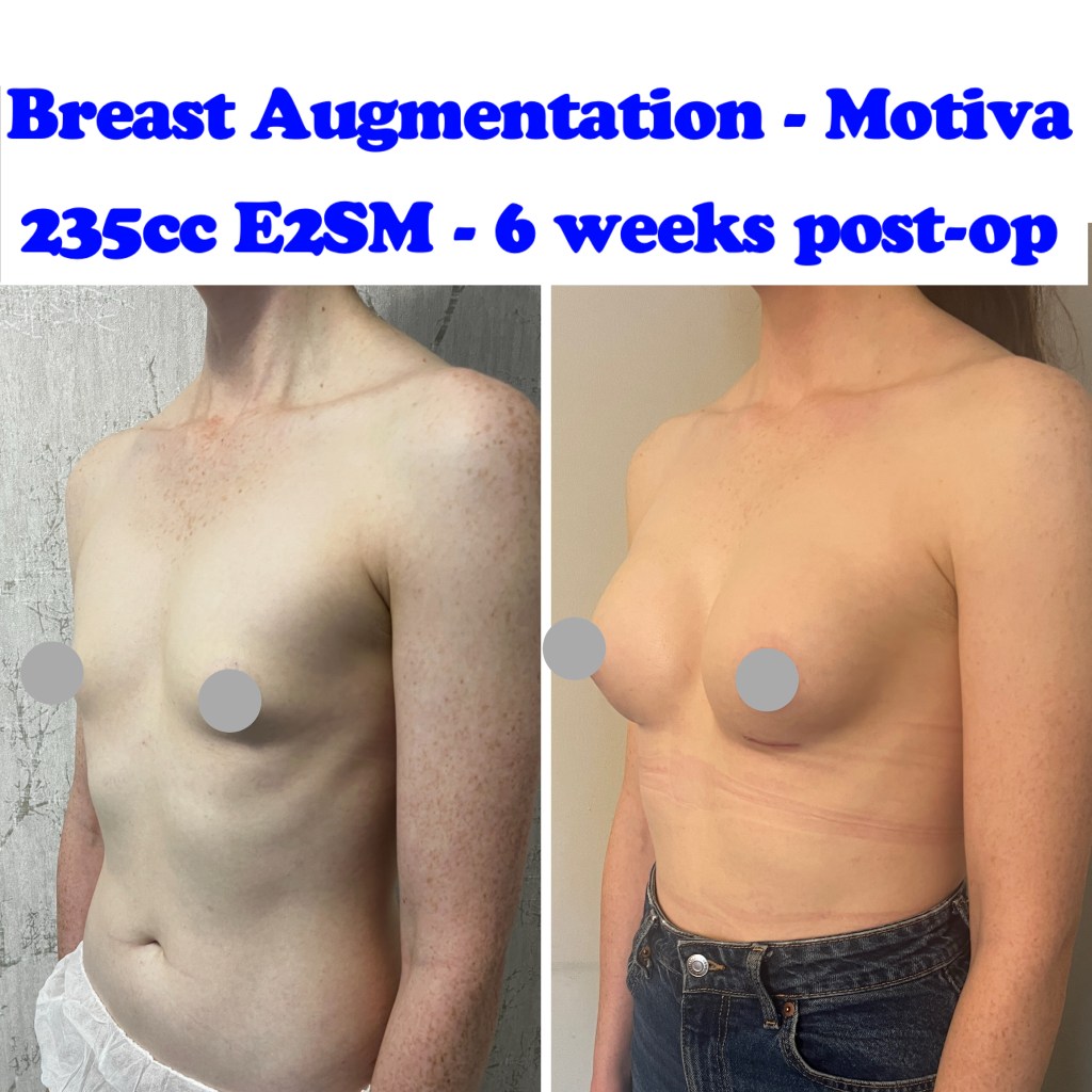 Breast Augmentation | Plastic Surgery | Harley Clinic, image size:1024x1024