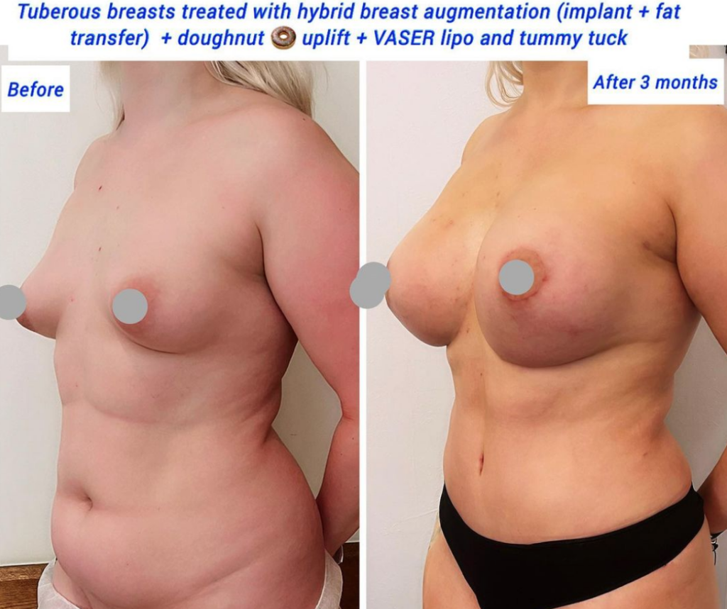 breast enlargement