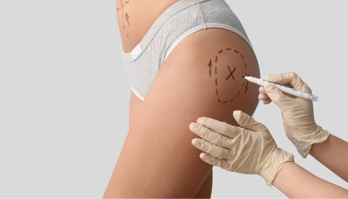 Hip Dips and Fat Transfer