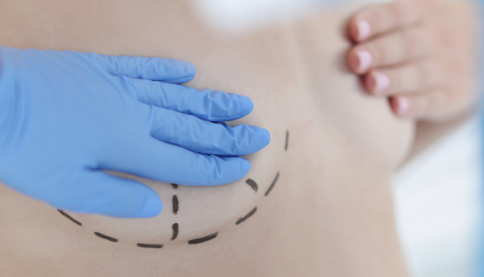 Breast Implant Removal