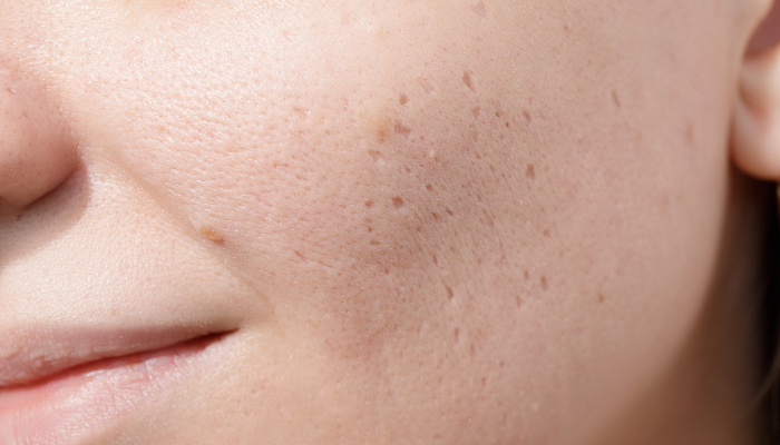 Treatment for Acne Scars